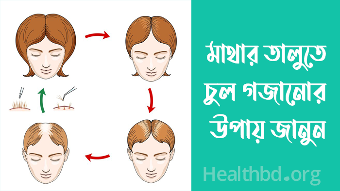 ন্যাড়া মাথায় চুল গজাতে কতদিন সময় লাগে
